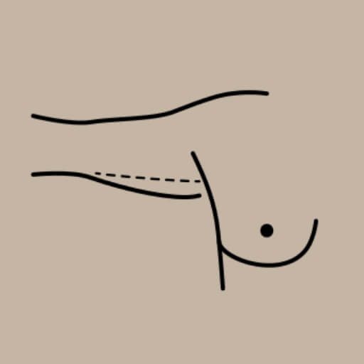 Brachioplasty Image