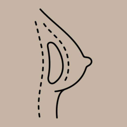 Breast Augmentation Image