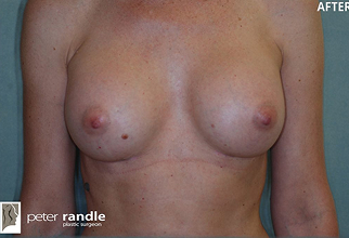 Breast Surgery After