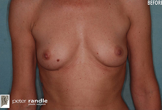 Breast Surgery Before